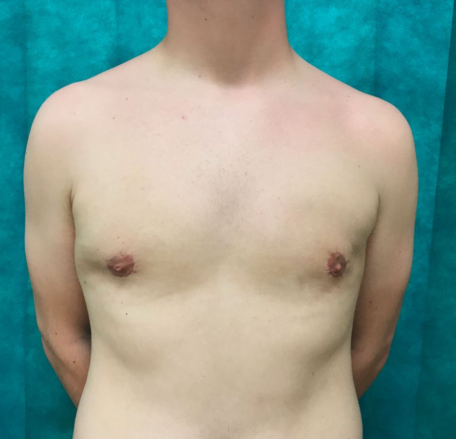 CB post-op 6 months
