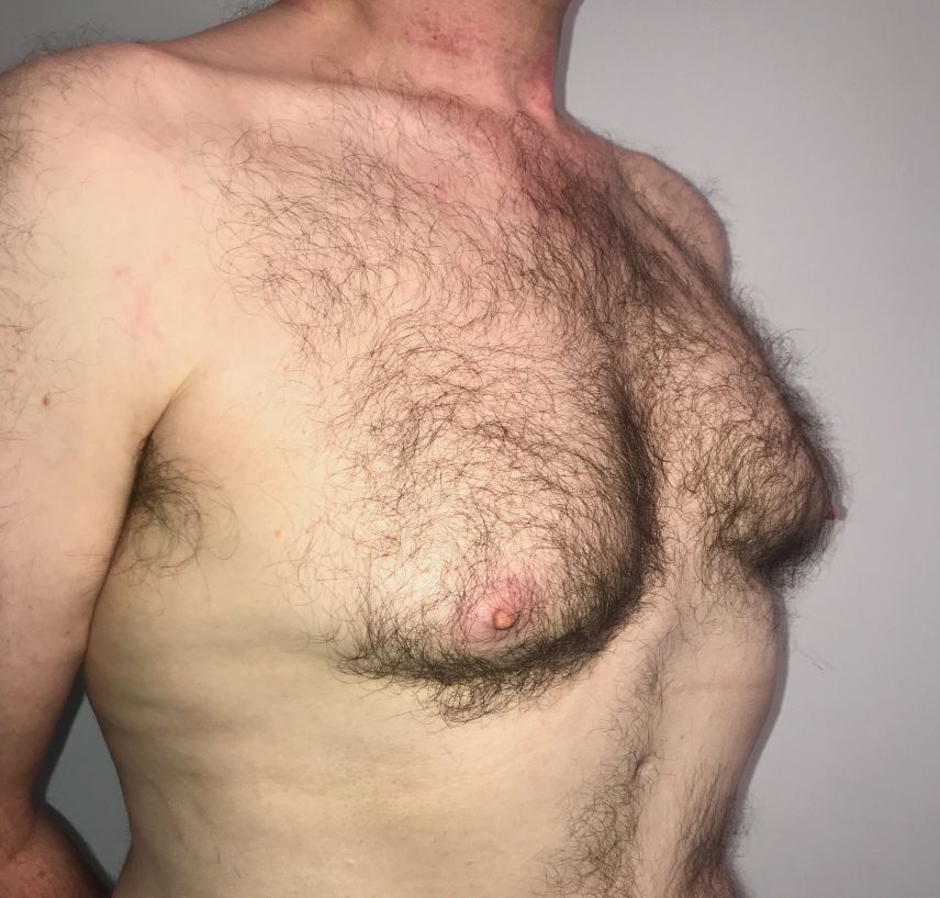 Right lateral pre-op gynae PR