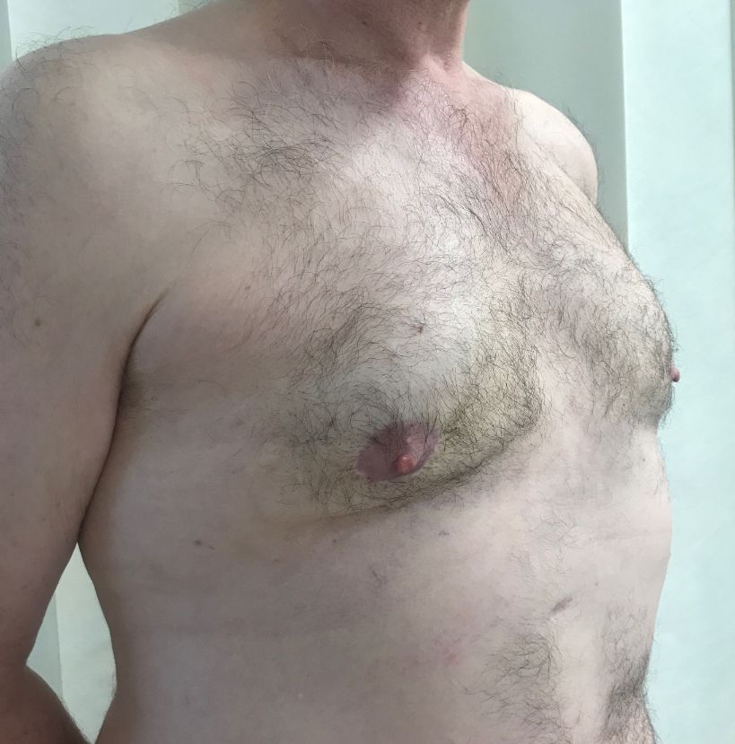 Right oblique gynae pre-op PR