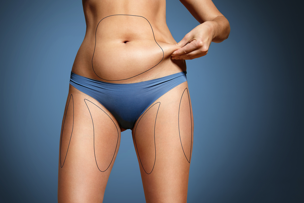 Liposuction Liposuction